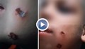 Разследват изгаряния от цигара по лицето на малко момче от Кърджали