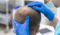 В Турция извършиха рекорден брой операции за присаждане на коси