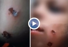 Детето е с четири наранявания по лицето които е получило