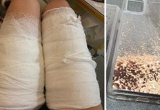 Дияна Плачкова била приета за лечение на химическо изгаряне на