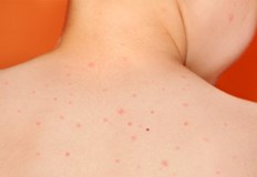 Основно боледуват деца на възраст от 1 до 9 годиниРъст