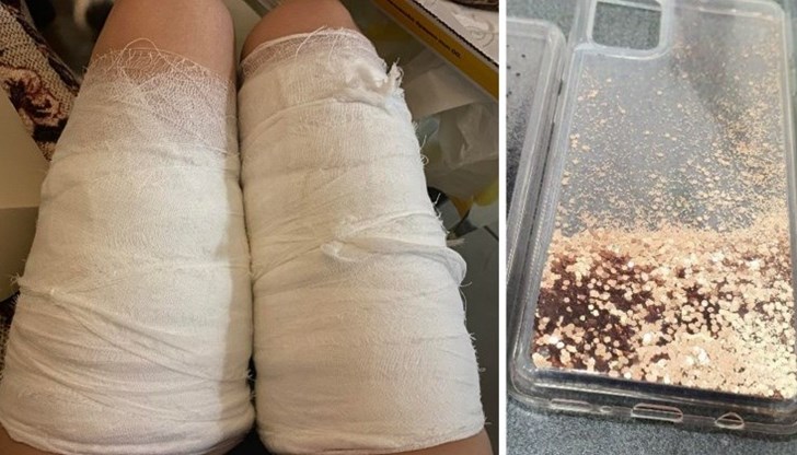 Дияна Плачкова била приета за лечение на химическо изгаряне на краката, след като количеството течност, с която е пълен калъфът, се изляла върху краката ѝ