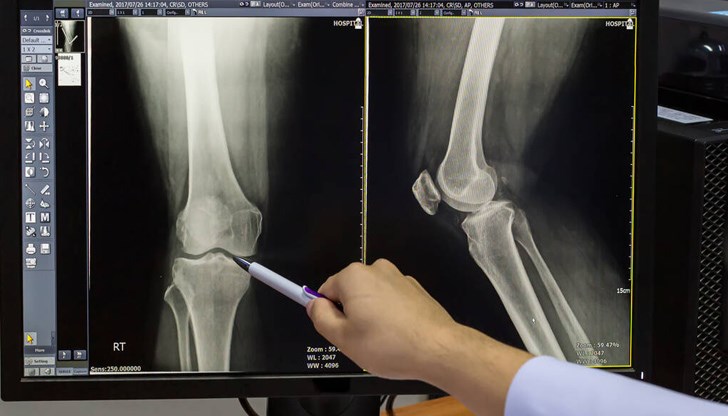 Ново проучване показва тревожна връзка между по-високите нива на замърсяване на въздуха и по-бързата загуба на костна маса