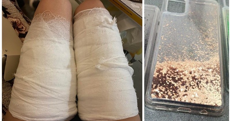 Дияна Плачкова била приета за лечение на химическо изгаряне на