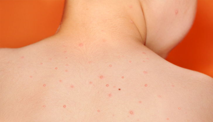 Основно боледуват деца на възраст от 1 до 9 годиниРъст