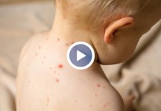 По често боледуващите са във възрастовия диапазон 5 12 годиниРъст