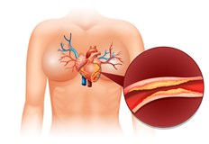 Холестеролът е жизненоважен за образуването на клетъчните мембраниВисокият холестерол може