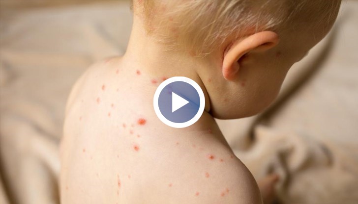 По-често боледуващите са във възрастовия диапазон 5 - 12 години