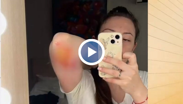 Животното захапало жената за ръката