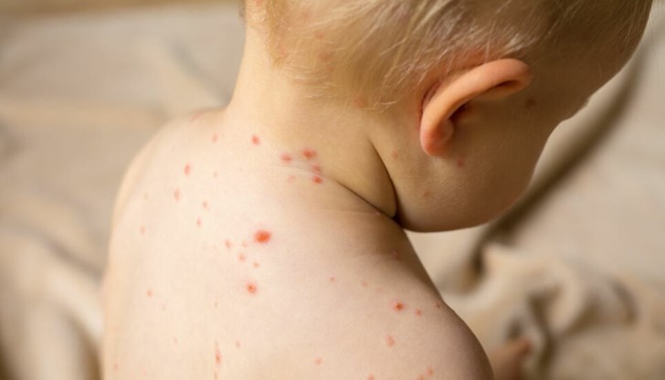 Имунизационният обхват срещу морбили с първа и втора доза в България е незадоволителен Имунизационният обхват срещу морбили с първа и втора доза в България е незадоволителен