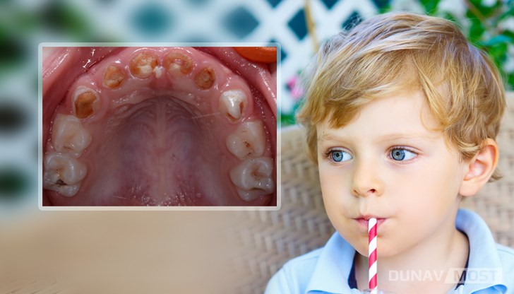 На снимката се виждат горните зъби на дете на 4 години, което не пие вода, а по 2 литра натурален сок дневно