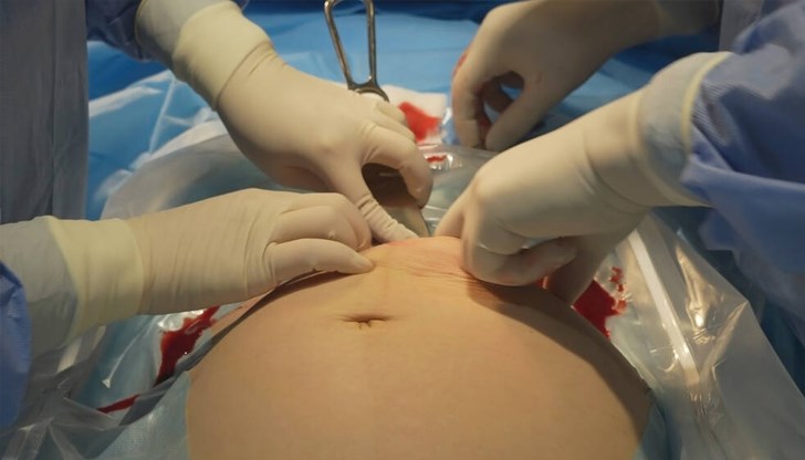 Всяко второ българче през 2022 г. е родено с операция