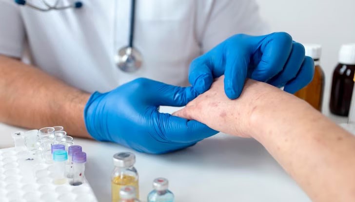 Повече от 87 000 случая на маймунска шарка бяха потвърдени в световен мащаб от началото на 2022 г. до 8 май тази година