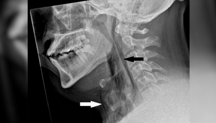 Опитът да заглушим кихането си може да не е най-добрата идея