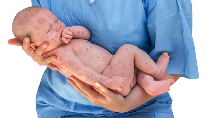 СЗО призова за спешна ваксинация СЗО призова за спешна ваксинация