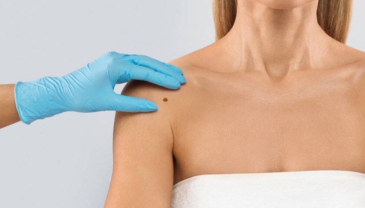 Тайните на бенките: Генетика, слънце и ранно откриване