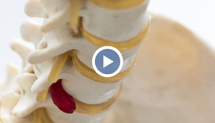 Заболяването може да се образува между всеки два прешлена на гръбначния стълб и във всяка една възраст