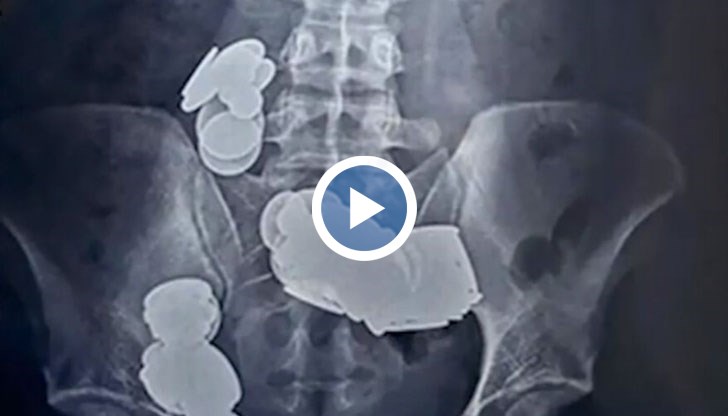 Мъжът е приет в болница, не можел да яде нищо почти месец