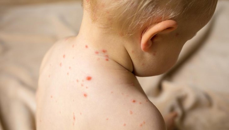 Според СЗО случаите на морбили са се увеличили през последните месеци и се очаква тази тенденция да продължи Според СЗО случаите на морбили са се увеличили през последните месеци и се очаква тази тенденция да продължи