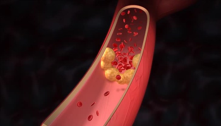 Няколко ключови фактора превръщат лошия холестерол в смъртоносна заплаха
