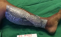 Рибена кожа заменя традиционните превръзки при тежки изгаряния