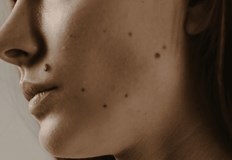 Дерматолози препоръчват редовни самопрегледи на кожата на всеки 3 4 месецаИзползването