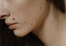 Дерматолозите обясняват ABCDE правилото за ранно разпознаване на риска от