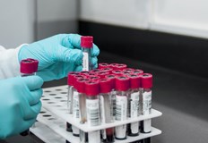 Как да разчетем кръвните си показатели и защо са важни