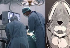 47 годишният пациент постъпил с тежка инфекция и абсцес във УМБАЛ