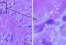 Нови изследвания разкриват тревожно натрупване на пластмасови частици в мозъка