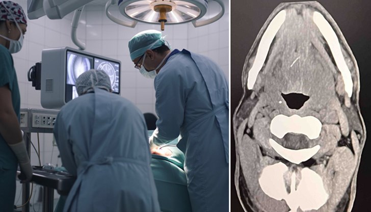 47-годишният пациент постъпил с тежка инфекция и абсцес във УМБАЛ "Каспела" 47-годишният пациент постъпил с тежка инфекция и абсцес във УМБАЛ "Каспела"