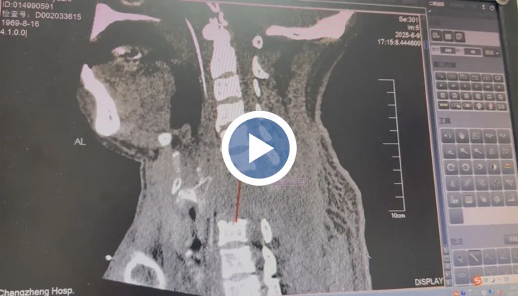 Лекарите използваха иновативна техника със "сателитни плочи" за първи път в света