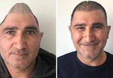 Турски хирурзи връщат надеждата на пациент с персонализиран титанов имплантИновативна