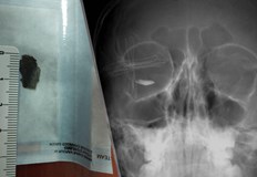 Метално чуждо тяло с размер 15 мм проникна в окото