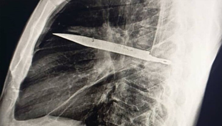 Тялото образувало защитна капсула около острието, която предотвратила сериозни увреждания Тялото образувало защитна капсула около острието, която предотвратила сериозни увреждания