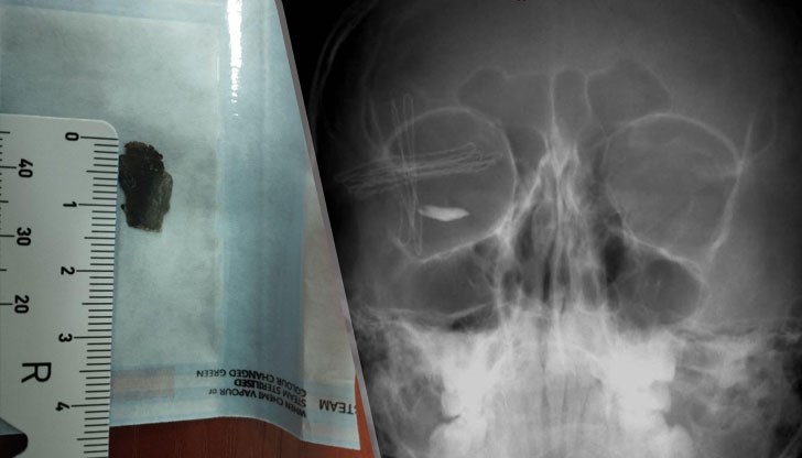 Метално чуждо тяло с размер 15 мм проникна в окото на детето при цепене на дърва