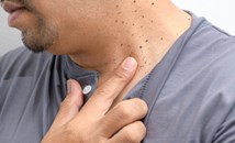 Народна рецепта премахва папиломи за пет дни