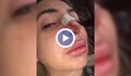Жена остана без нос след операция при лекар с фалшива диплома