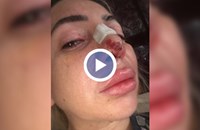 Жена остана без нос след операция при лекар с фалшива диплома