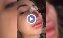 Жена остана без нос след операция при лекар с фалшива диплома