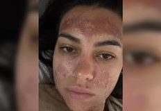 Потърпевшата ще се възстановява месеци след химическо изгаряне втора степен30 годишна
