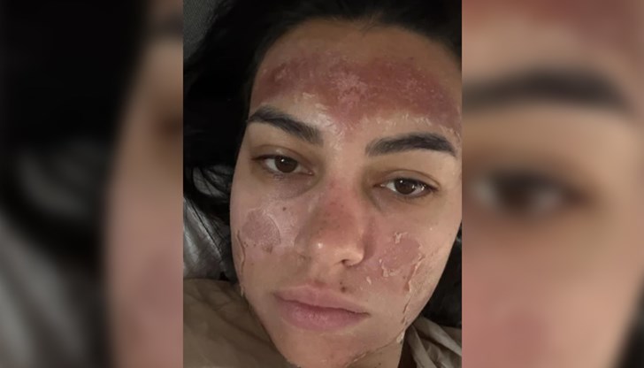 Потърпевшата ще се възстановява месеци след химическо изгаряне втора степен Потърпевшата ще се възстановява месеци след химическо изгаряне втора степен