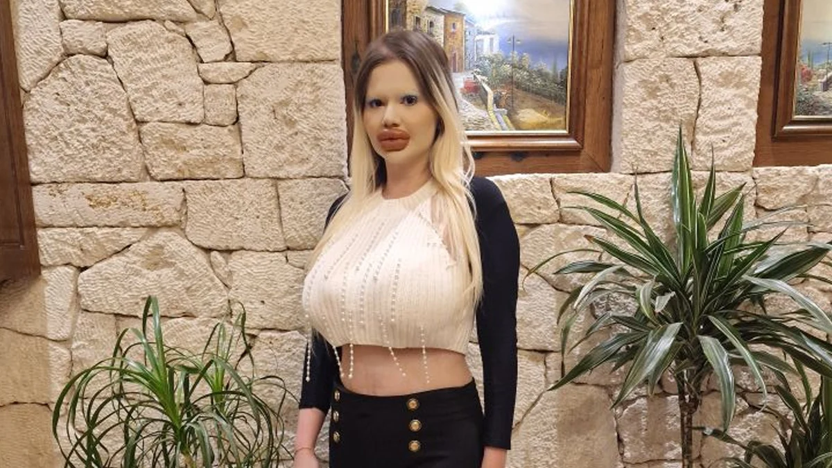 Притежателката на най-големите устни в света заяви, че е готова