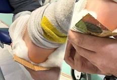 Още едно дете получи картонена шина в Спешния центърМедицински специалисти