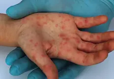 Заразата се разраства на фона на сринат имунизационен обхватОбщо 43