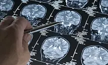 Български медици разкриха менингит с тежки психиатрични симптоми