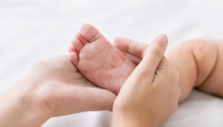 89% от инфектираните с дребна шарка у нас са деца 89% от инфектираните с дребна шарка у нас са деца