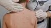Започва безплатна имунизация срещу варицела