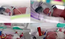 1 на 15 милиона: Австралийка роди еднояйчни четиризнаци
