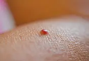 Какво означават малките червени точки по кожата